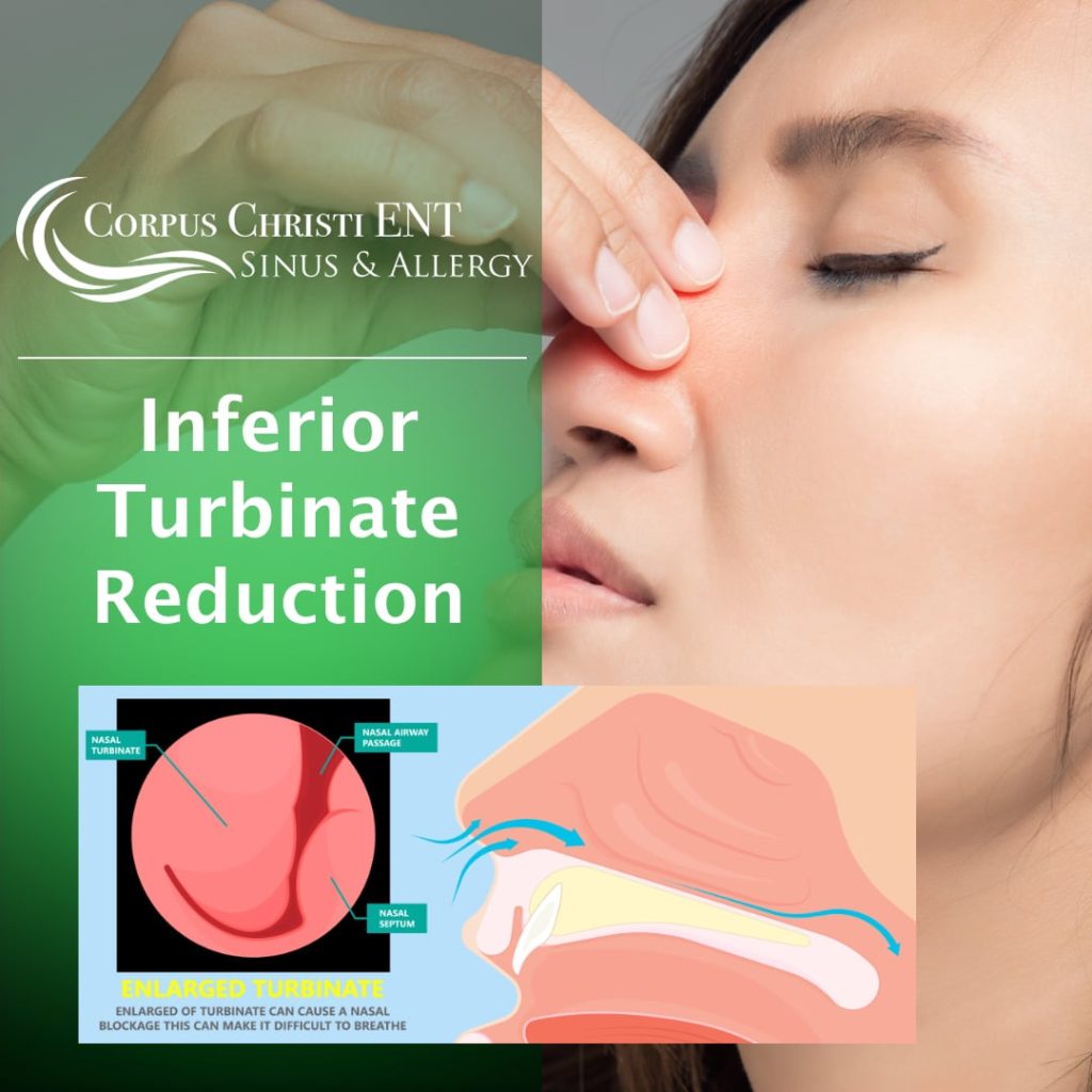 Inferior Turbinate Reduction Corpus Christi ENT Sinus & Allergy