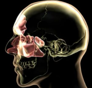 Illustration of balloon sinuplasty