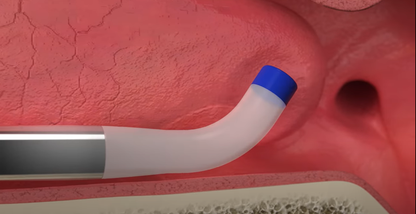 Eustachian Tube Dilation Corpus Christi ENT Sinus & Allergy