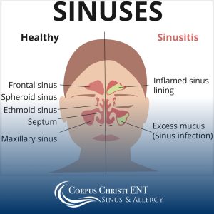 Illustration of the sinuses