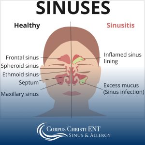 In-office Sinus Endoscopy