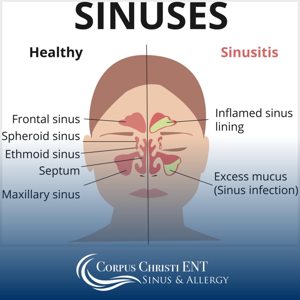 Illustration comparing healthy sinuses to sinusitis sinus infection